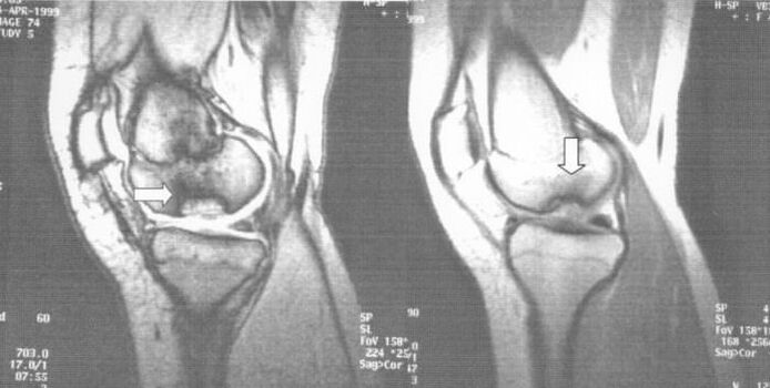 x-ray ng osteochondrosis dissecans sa joint ng tuhod