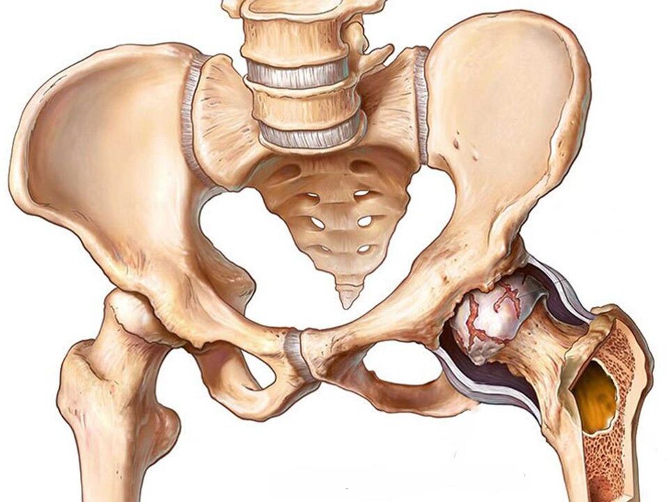 arthrosis ng hip joint
