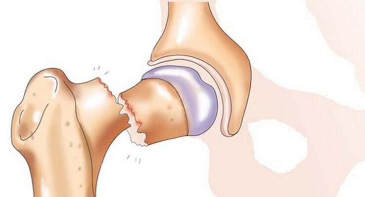 Ang femoral neck fracture ay sinamahan ng matinding sakit sa hip joint