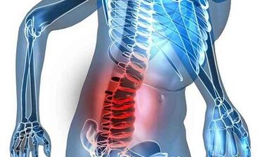 Mga palatandaan at sintomas ng lumbar osteochondrosis