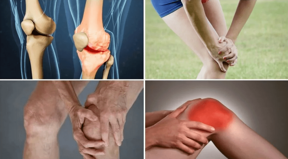 Mga sintomas ng arthrosis
