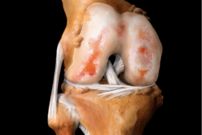 pinsala sa kasukasuan ng tuhod dahil sa arthrosis