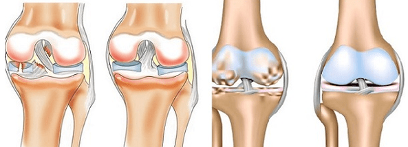 Arthritis at arthrosis