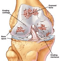Ang mekanismo ng pag -unlad ng arthrosis